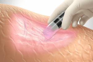 morpheus8 radiofrequency energy and microneedling