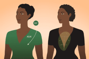 traditional breast lift pros and cons